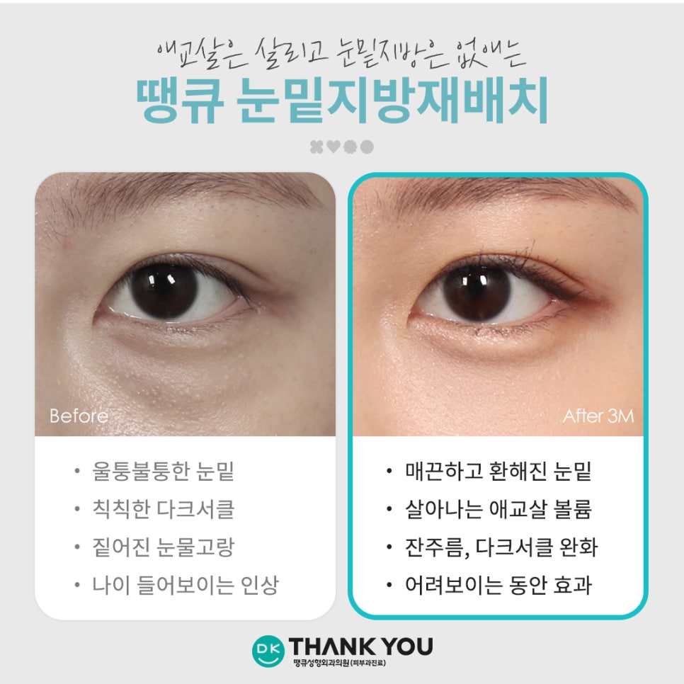 A Place That Does Lower Eyelid Fat Repositioning Well — Complete a Smooth, Refreshed Under-Eye Look at Thank You! image 7