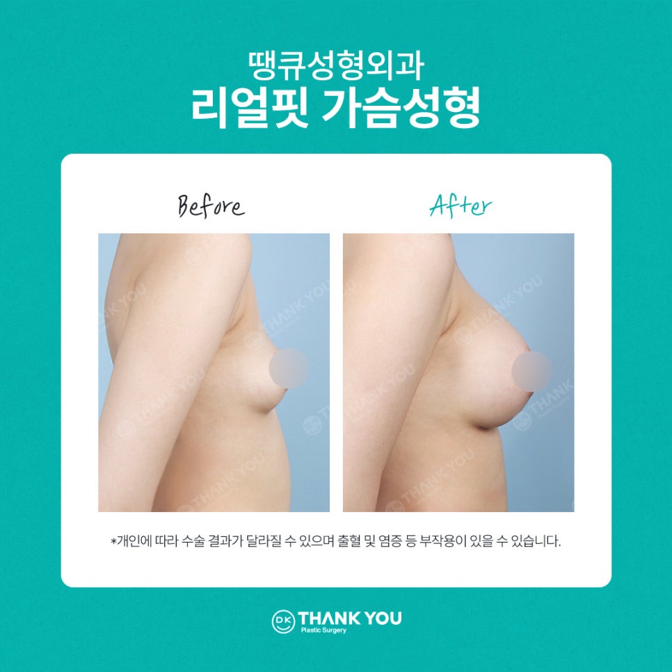 땡큐성형외과 멘토가슴성형 이벤트✨ 관련 이미지 9