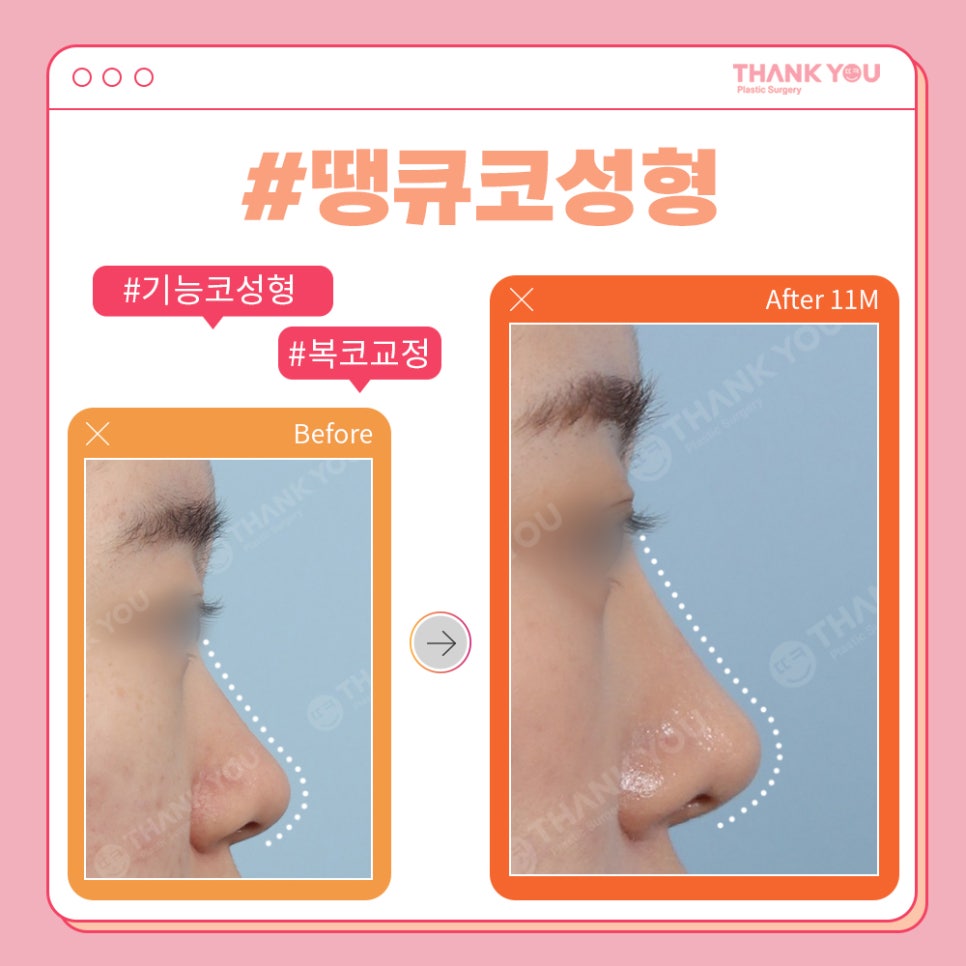 코성형 전후, 코모양 신논현역 성형외과에서 체크 관련 이미지 9
