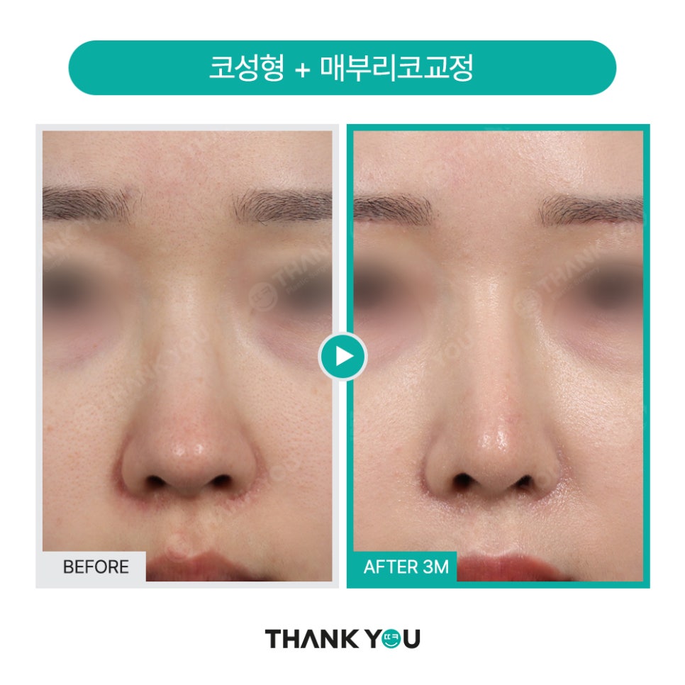 넓은코, 큰코성형 매부리코교정 찾는다면? 관련 이미지 4