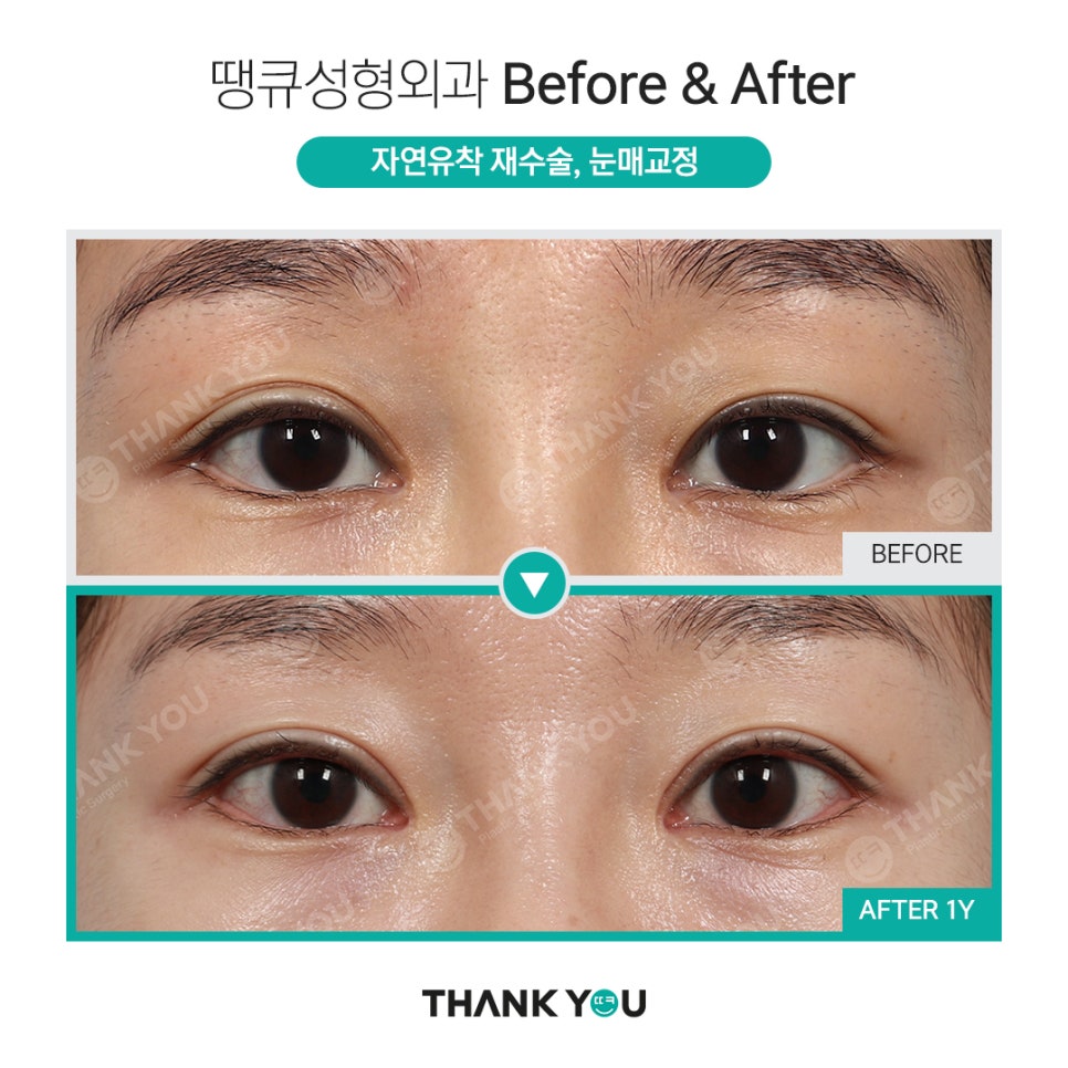 쌍수 풀기 (재수술전 실풀기+ 눈재수술 전후) 관련 이미지 2