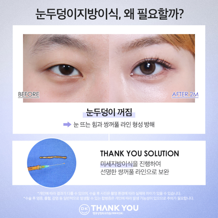 Improving Small, Faint Eyes with Non-Incisional Eye Correction Surgery ✨ (Make Me Girl Episode 7 Thank You Solution) image 6