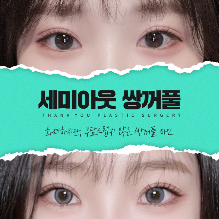 쌍수잘하는곳에서 세미아웃라인쌍꺼풀로 예쁜 눈 변신! 관련 이미지 1