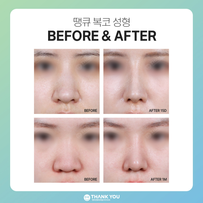 복코성형 전후, 명확한 차이를 만들고 싶다면?! 관련 이미지 6