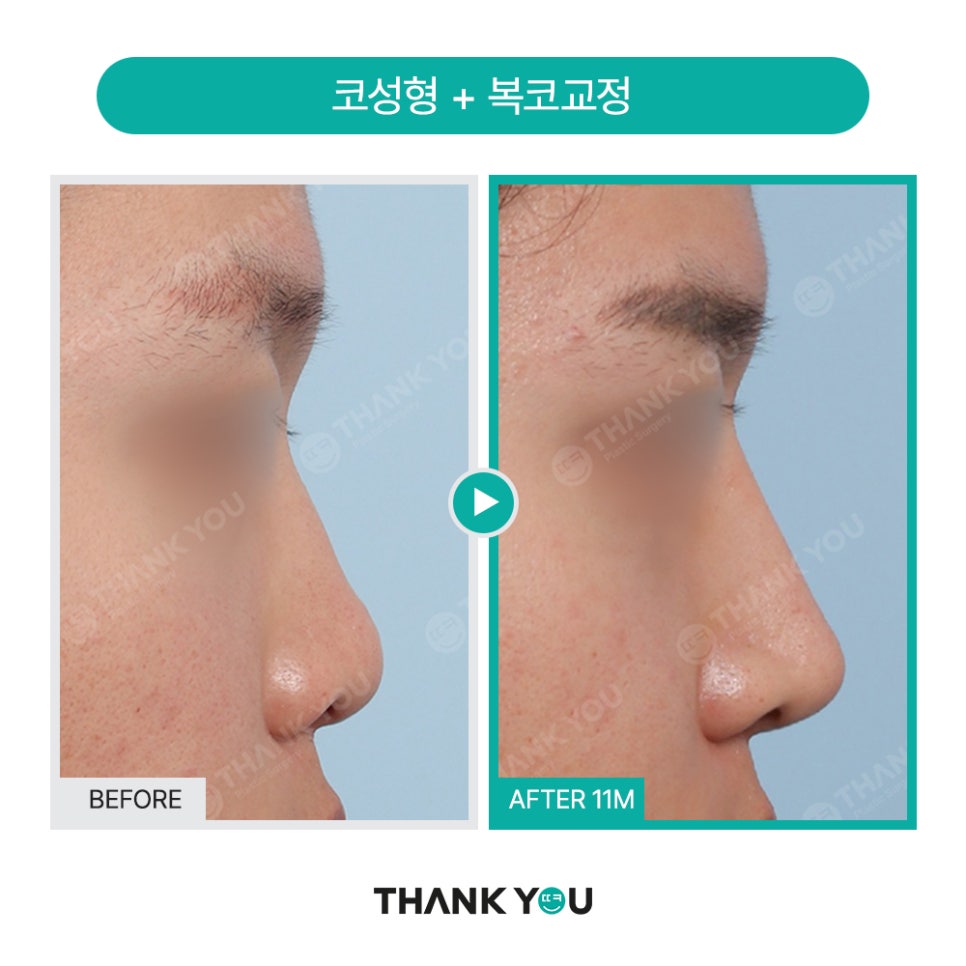 이런 코는 무조건 성공?! 코성형 성공 유형 관련 이미지 11