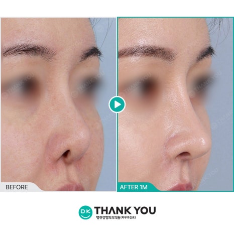 Beyond Simple Correction to Tissue Regeneration! What If Stem Cell Therapy Is Applied to Revision Rhinoplasty? image 2