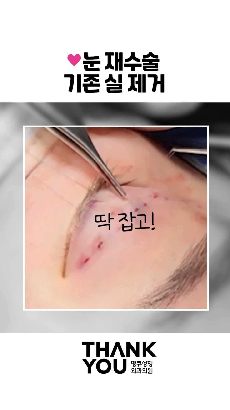 매몰 풀기, 매몰 실 제거 (15년 묵은 실)재수술 쌍꺼풀 관련 이미지 5