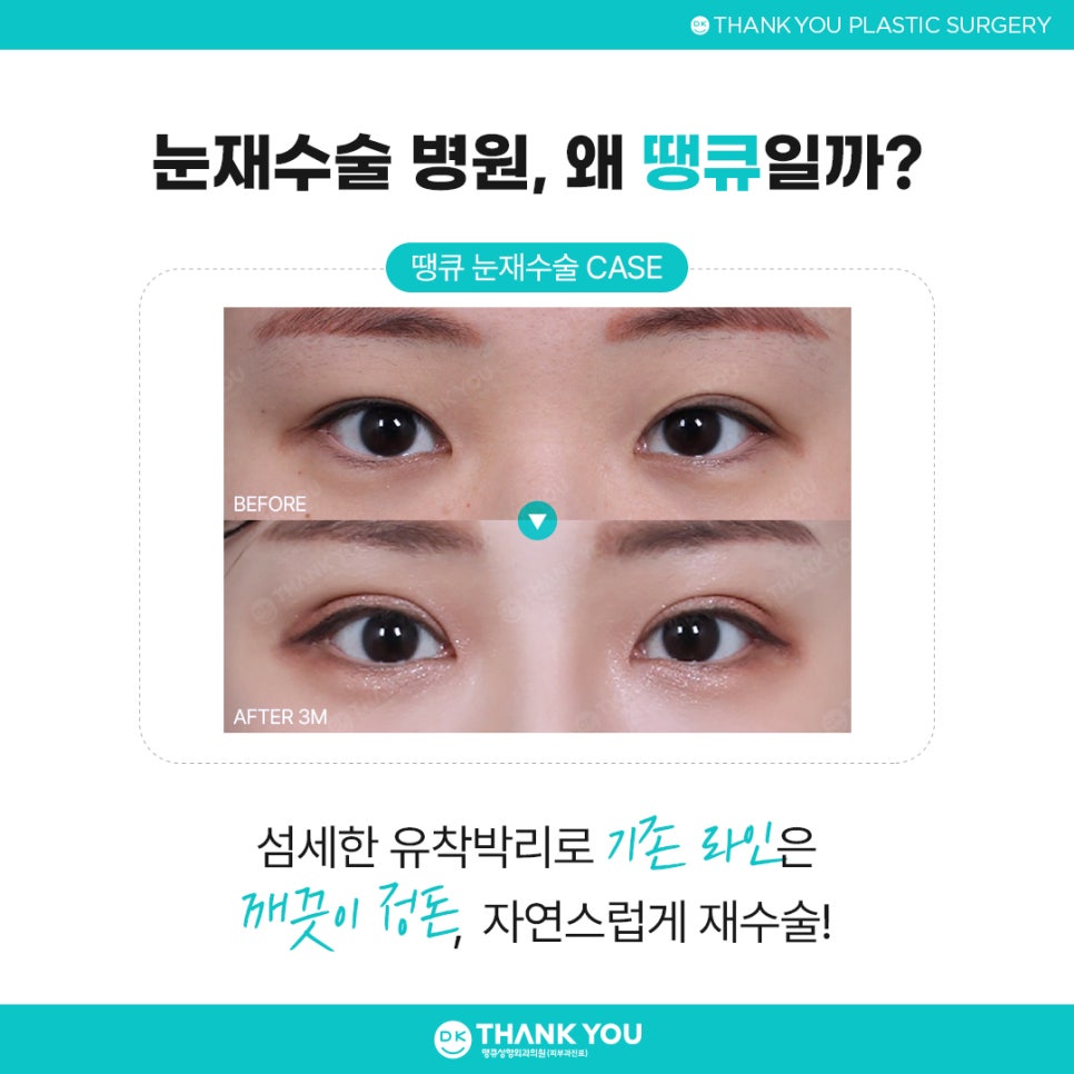 눈재수술병원 잘 고르려면?! 맞춤 수술 여부가 핵심👍 관련 이미지 9