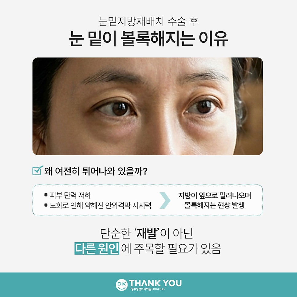 눈밑지방재배치 재발? 수술 후 눈 밑이 볼록한 이유 관련 이미지 2