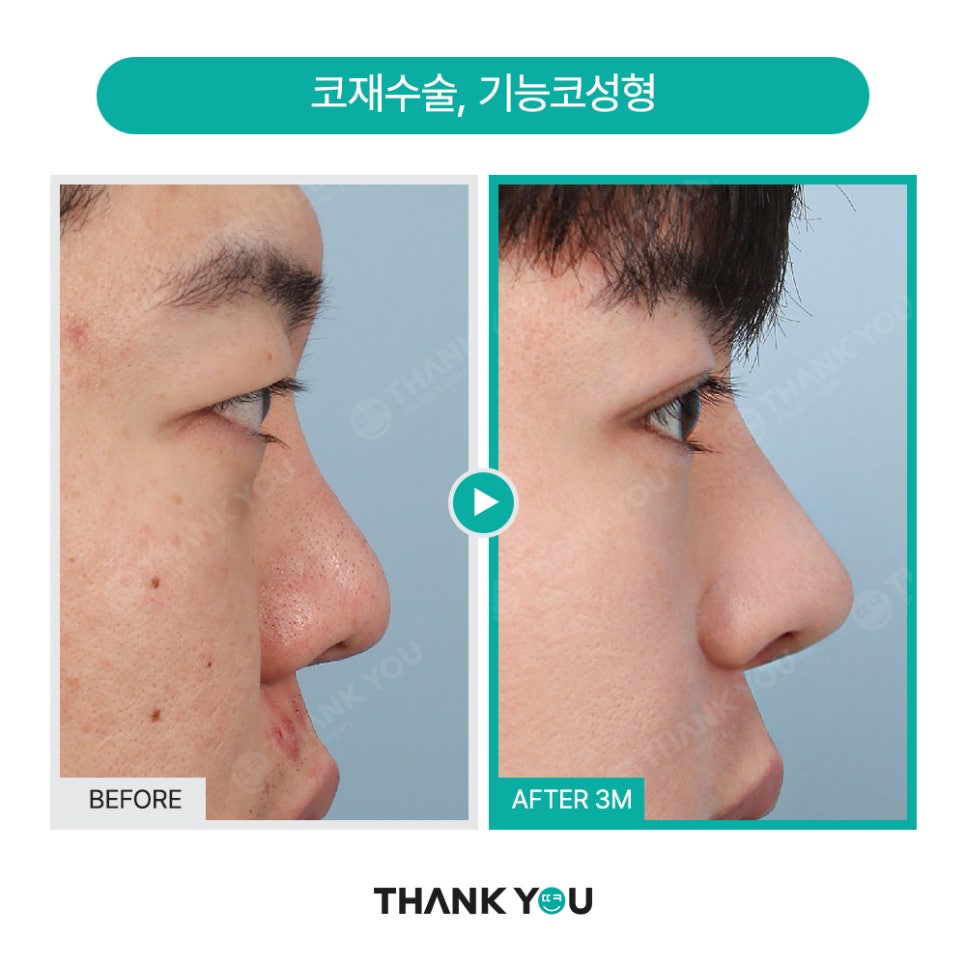 땡큐 맥미남, 뮤지컬배우 남자 복부지방흡입 전후 Check 관련 이미지 12