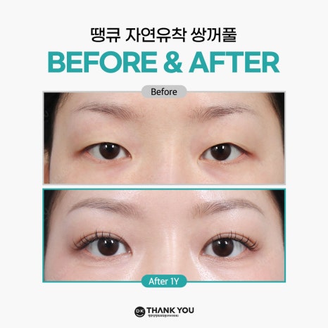 쌍꺼풀잘하는병원 땡큐에서 알려주는 절개vs비절개 수술법의 특징! 관련 이미지 9