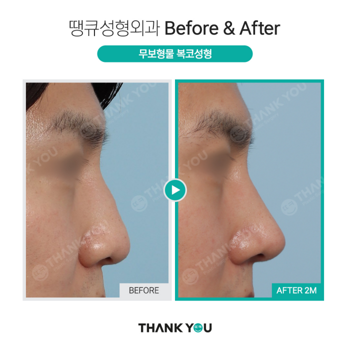 첫코성형, 자연스러운 결과를 원한다면?! >> 무보형물코성형 관련 이미지 9