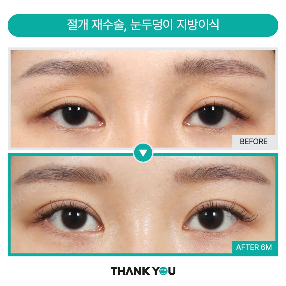 눈재수술 실패하지 않으려면? 눈 재수술유형&전후 체크 관련 이미지 11