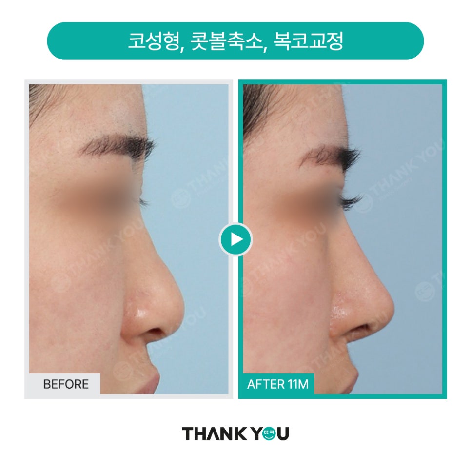 코성형 아직도 L자보형물? 실리콘 선택 기준은? 관련 이미지 11