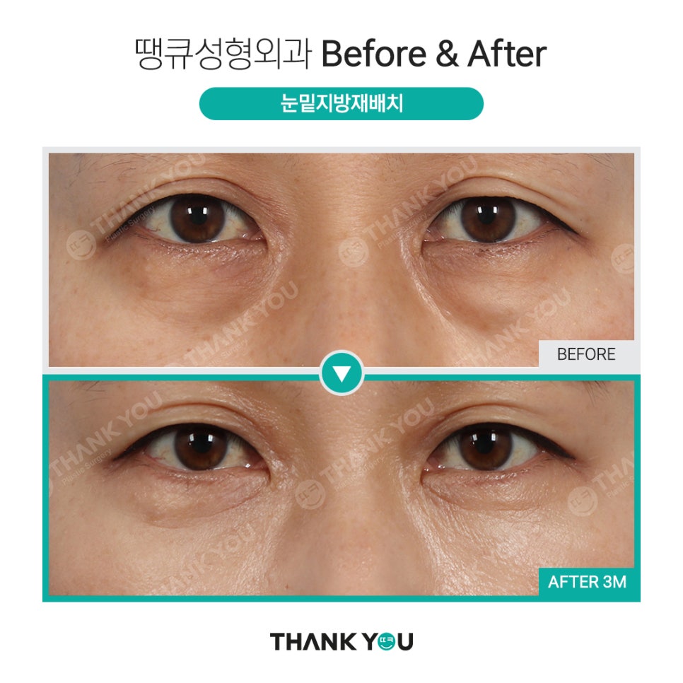 눈밑성형에 격막 강화란 무엇인가요? [눈밑지] 관련 이미지 12