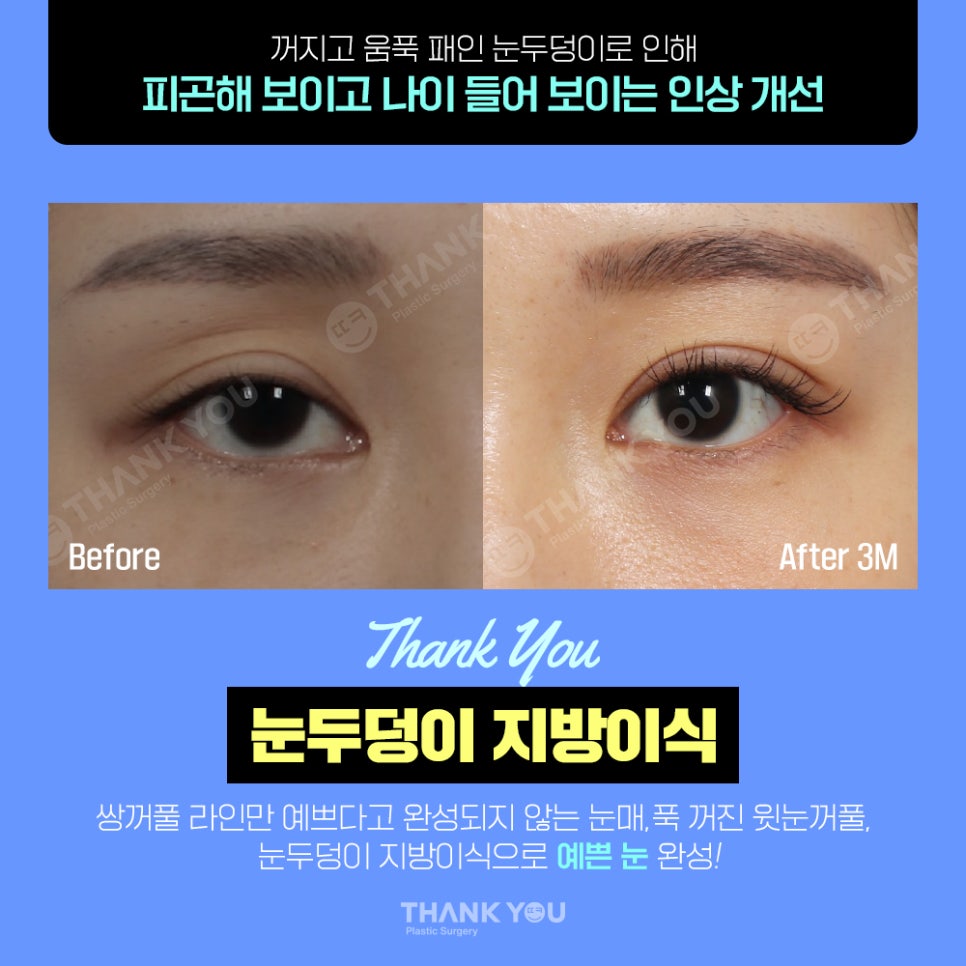눈두덩이 지방이식, 푹꺼진 눈꺼풀에 자가지방이식으로 관련 이미지 4