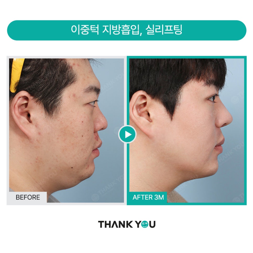 땡큐 맥미남, 뮤지컬배우 남자 복부지방흡입 전후 Check 관련 이미지 15