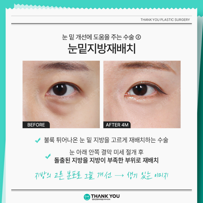 Lower Blepharoplasty and Under-Eye Fat Repositioning: What’s the Difference? image 5
