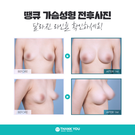 가슴성형보정브라 & 윗밴드 꼭 착용해야 할까요? 관련 이미지 7