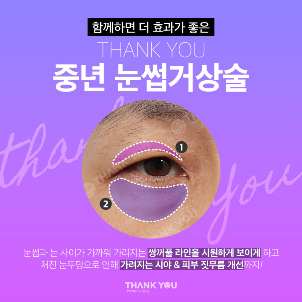 중년눈수술, 50대 60대 눈처짐과 눈꺼풀짓무름 해결법 관련 이미지 12