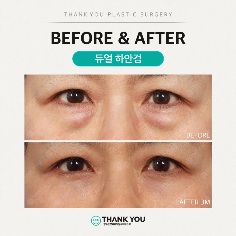 중년눈성형, 하안검수술비용 알아보기 전 이것만은 알고 가세요 관련 이미지 3