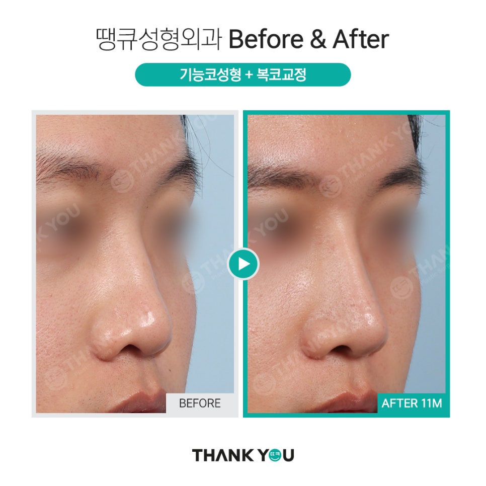 강남 코성형 전후, 코수술 잘하는 곳? 관련 이미지 2
