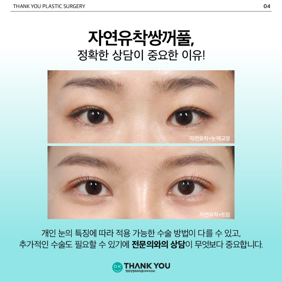 Natural Adhesion Double Eyelids: If You Want Naturalness That Lasts Longer image 5