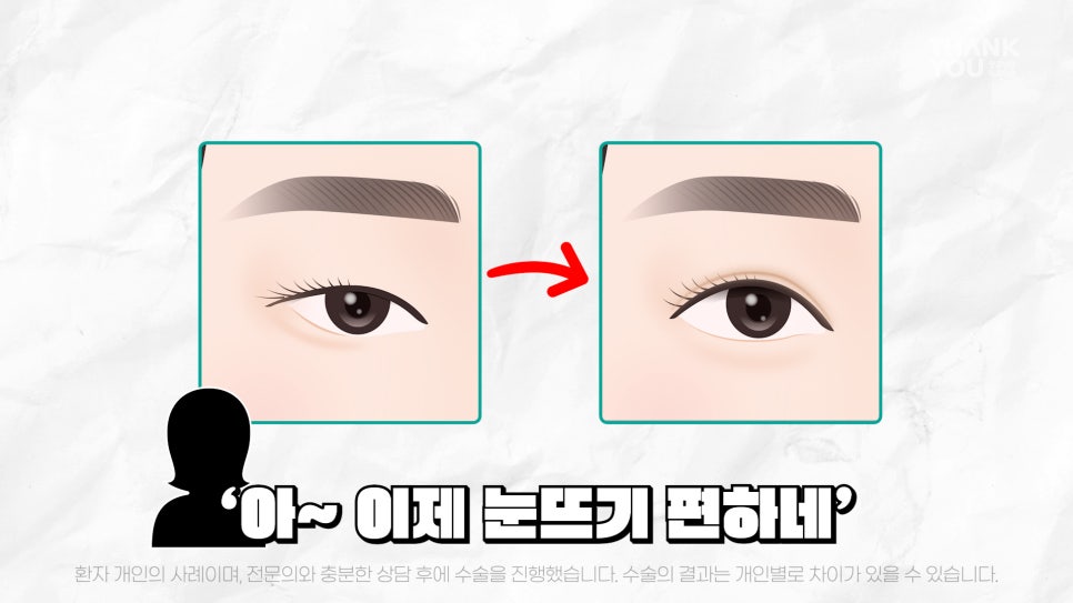 중년눈성형 전후& 이마거상+눈썹하거상+쌍수로 젊어지기 관련 이미지 19