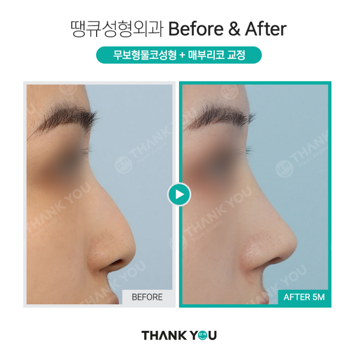 첫코성형, 자연스러운 결과를 원한다면?! >> 무보형물코성형 관련 이미지 5