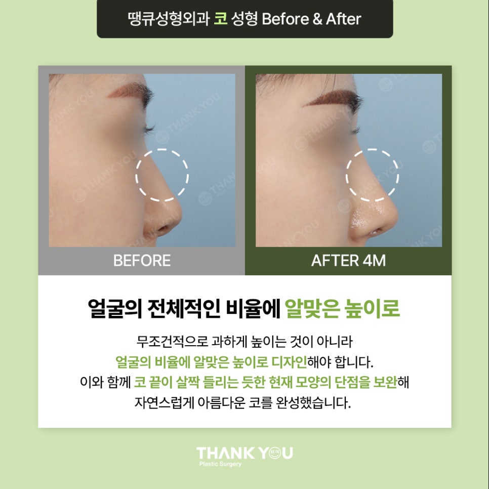 코수술, 모양에 따른 디자인이 중요 포인트 관련 이미지 6