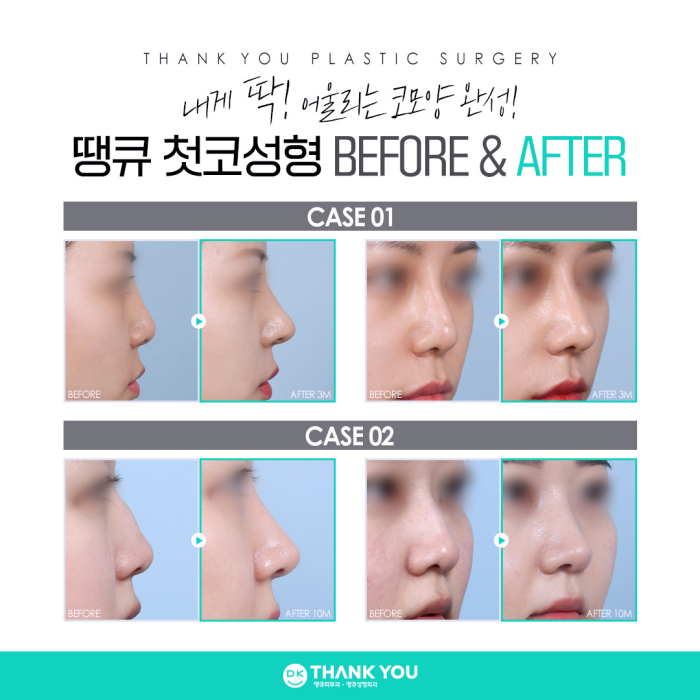 첫코성형은 코수술잘하는곳에서, 내게 딱 맞게! 관련 이미지 7