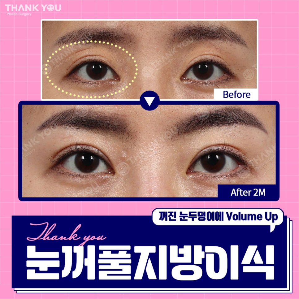 눈꺼짐? Thank You눈꺼풀 지방이식으로 볼륨UP 관련 이미지 2