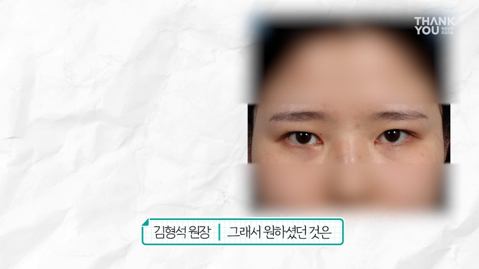 눈재수술 할 때 이마거상 추천하는 이유는? (눈썹올림술 전후) 관련 이미지 9