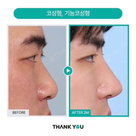[맥미남 병원] 남자 휜코 성형, 막힌코수술, 코막힘 등 전후 까지 관련 이미지 8