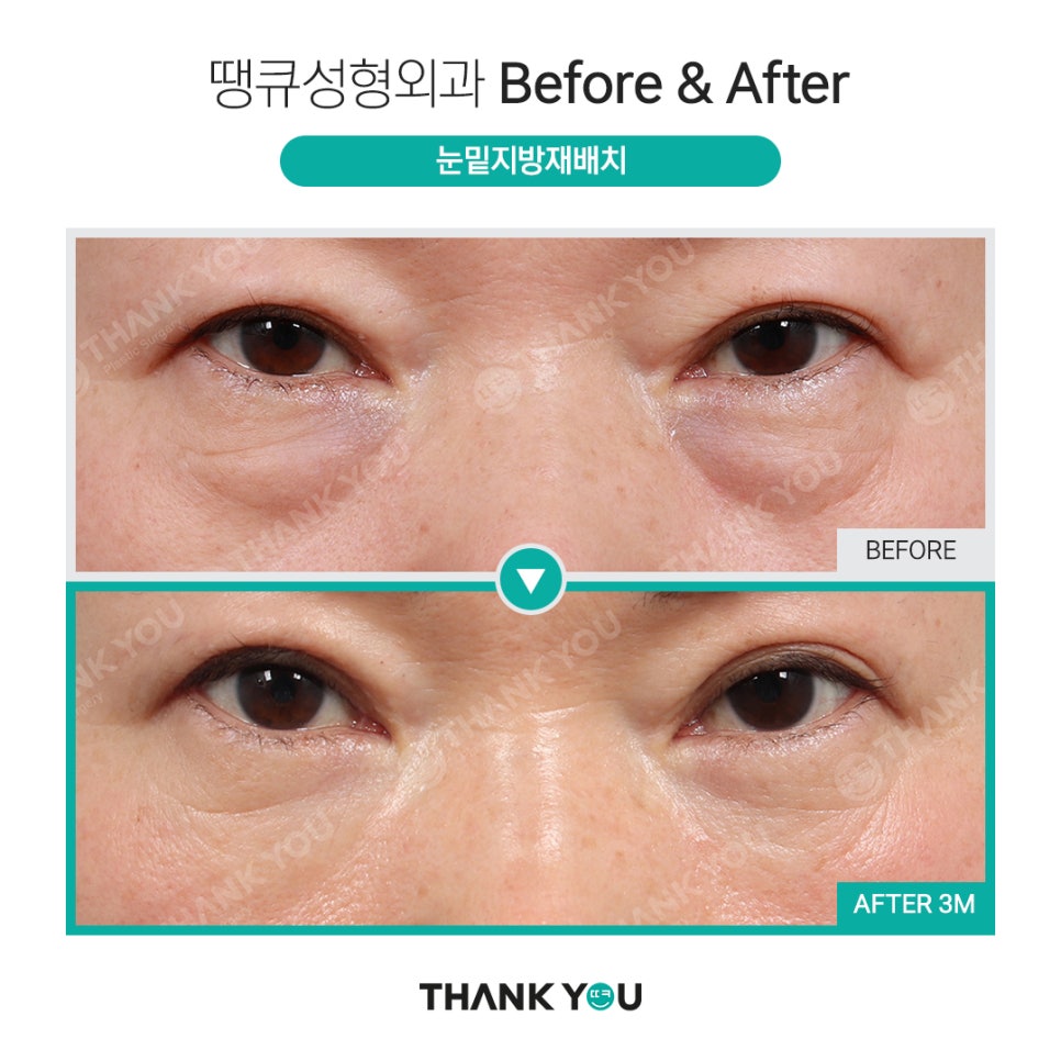 눈밑 필러 넣었는데 눈밑지방재배치 가능할까요? (이호준 칼럼) 관련 이미지 11