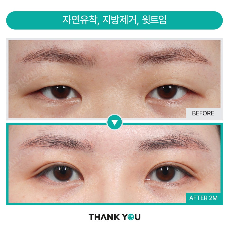 가로로 긴 눈은 어떤 쌍꺼풀라인이 어울릴까요? 관련 이미지 9