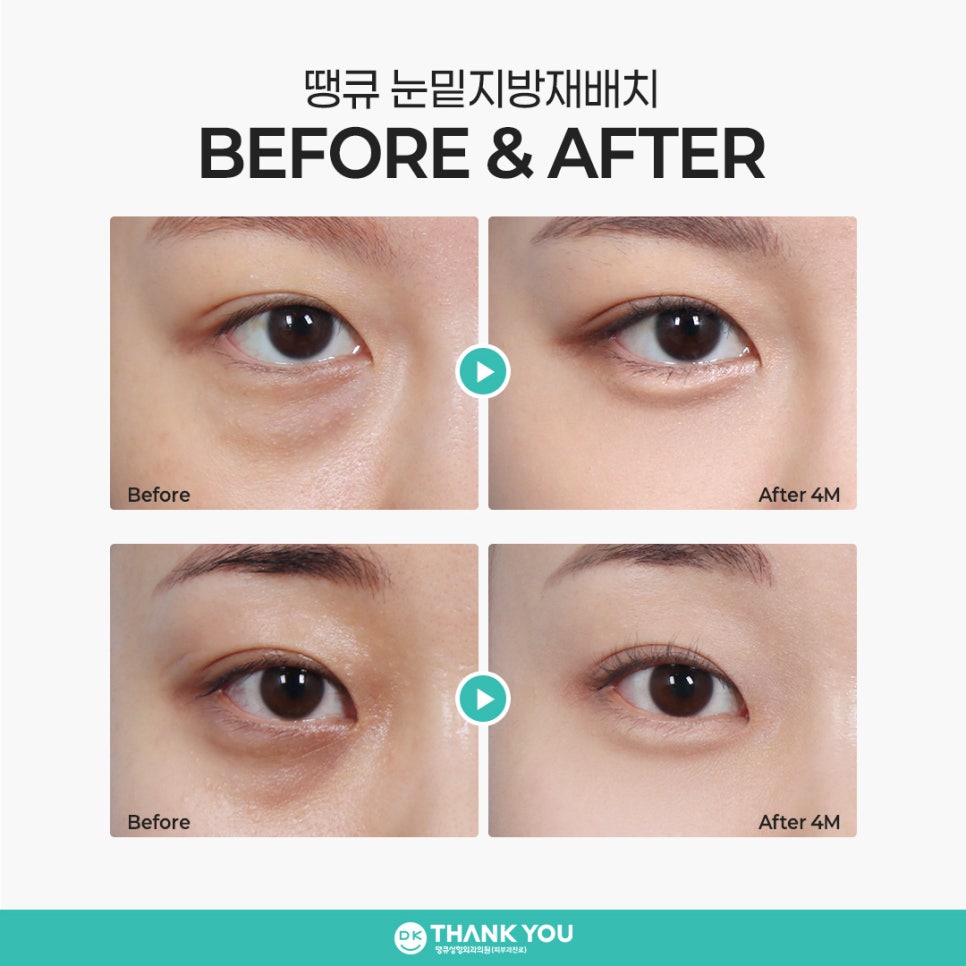 Choosing an Under-Eye Fat Repositioning Clinic: Want Natural, Long-Lasting Results? image 8