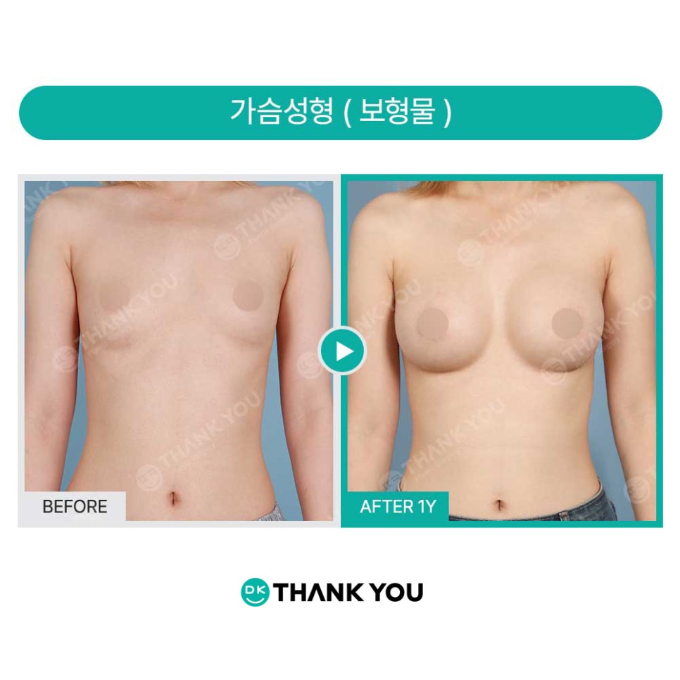 가슴수술주의사항 관련 이미지 7