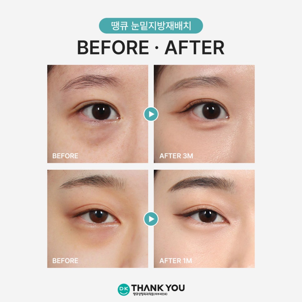 눈트임수술을 이미 했다면, 눈밑지 수술해도 괜찮을까?! 관련 이미지 4
