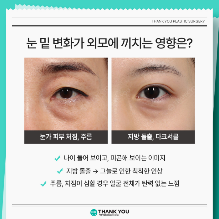 Lower Blepharoplasty and Under-Eye Fat Repositioning: What’s the Difference? image 2