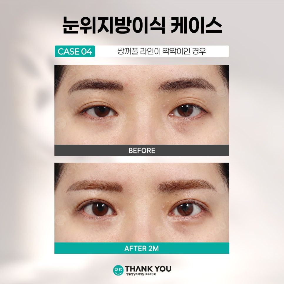 눈꺼풀꺼짐 개선하려면? 꺼진눈지방이식 전에 알아야 할 3가지 관련 이미지 7