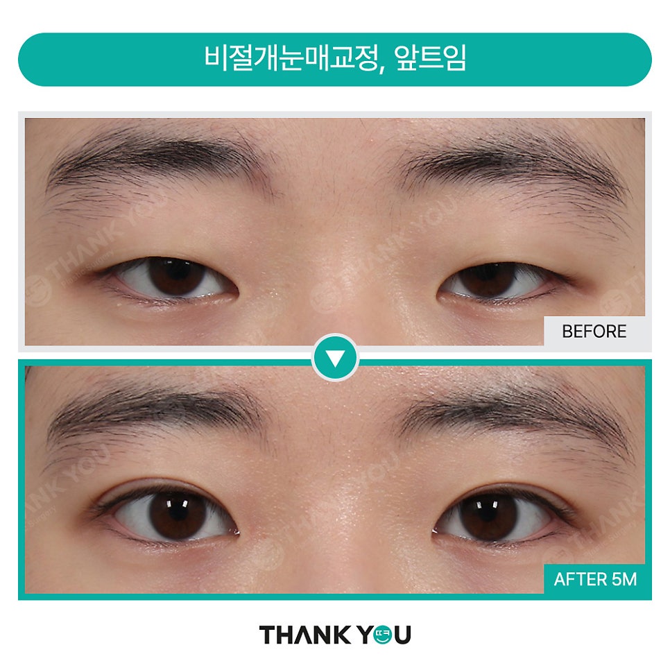 가로로 긴 눈은 어떤 쌍꺼풀라인이 어울릴까요? 관련 이미지 8