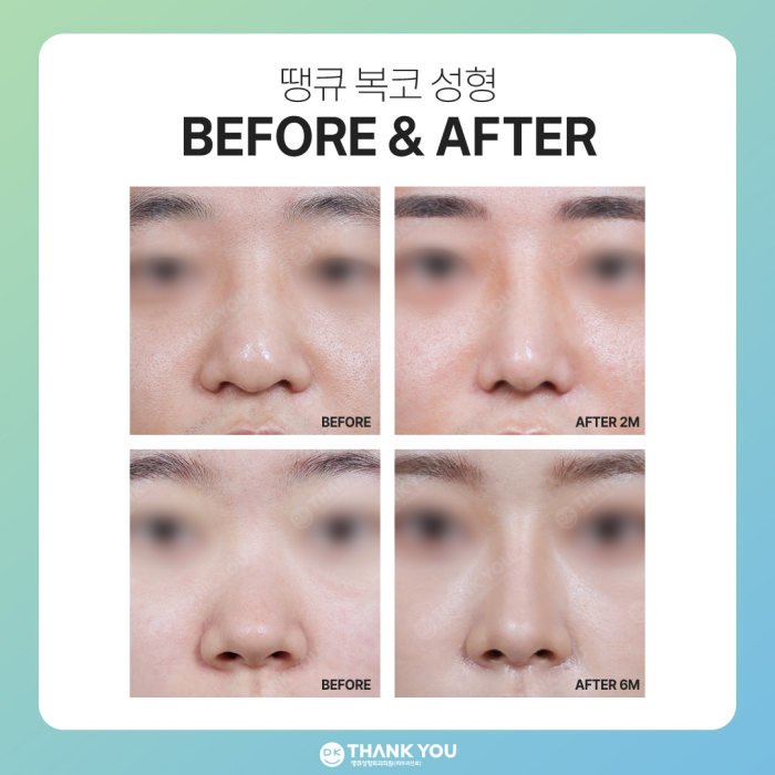 복코성형 전후, 명확한 차이를 만들고 싶다면?! 관련 이미지 8