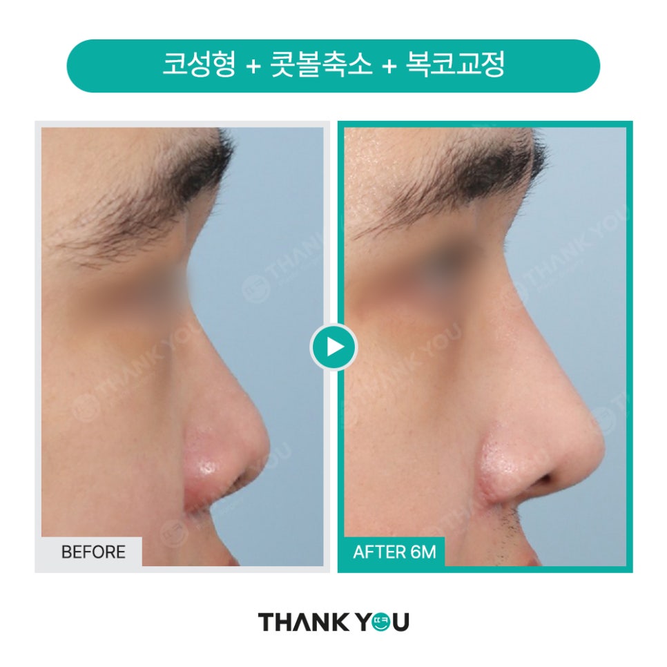 신논현역 성형외과, 남자 휜코성형, 매부리코 성공 포인트는? 관련 이미지 4
