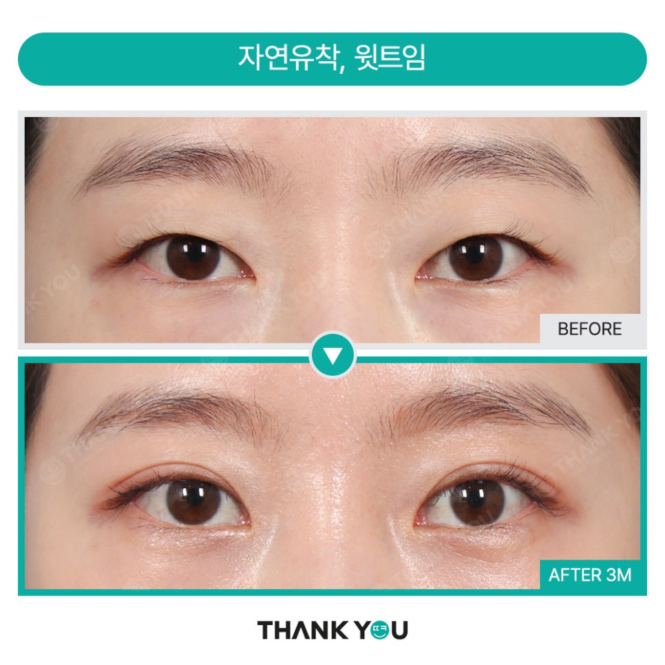 [비절개눈매교정+앞윗트임+눈밑지] 자고 일어났을 뿐인데 제니가?! 관련 이미지 24