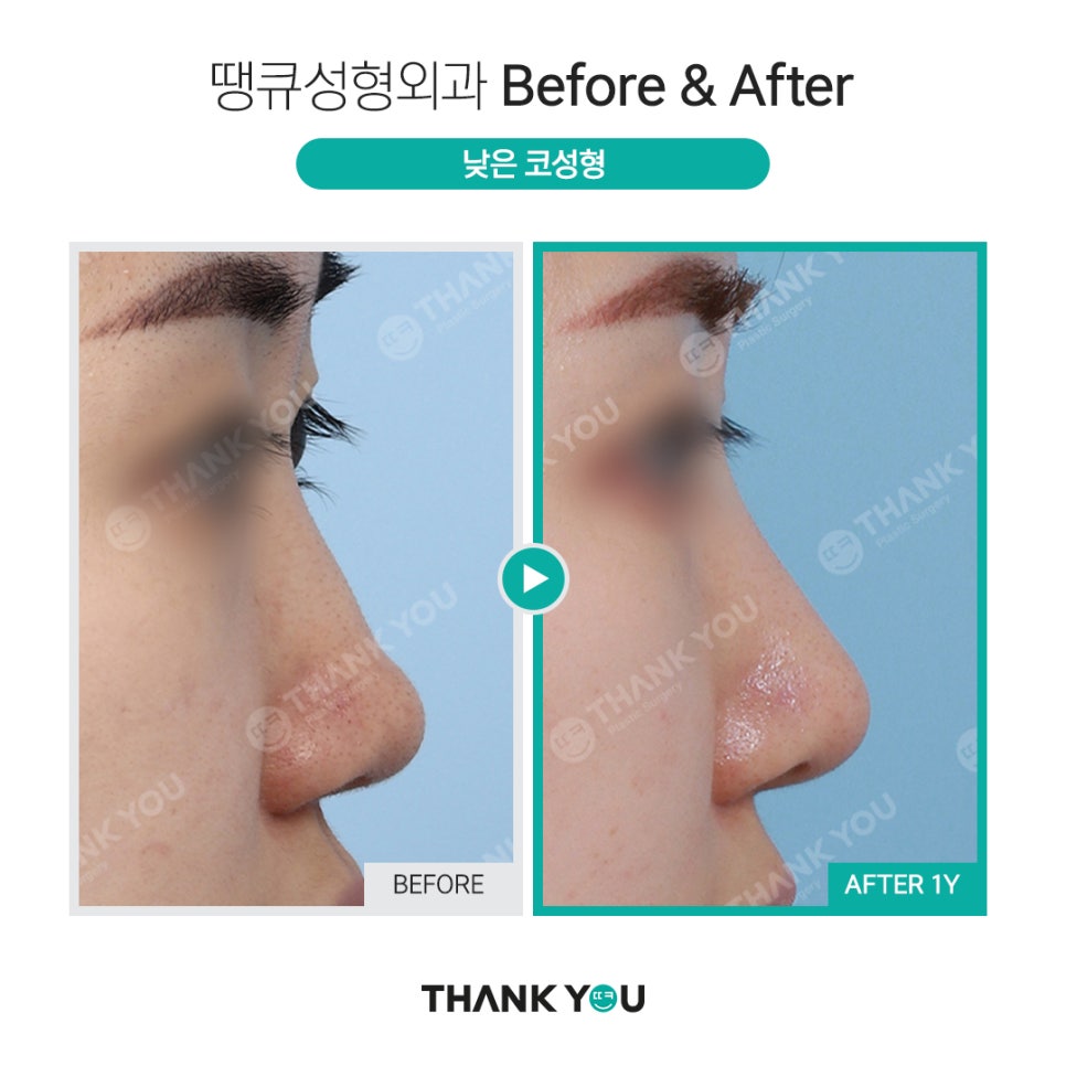 코성형 실리콘 비침, 코낮추기 재수술로 매끈하게 관련 이미지 21
