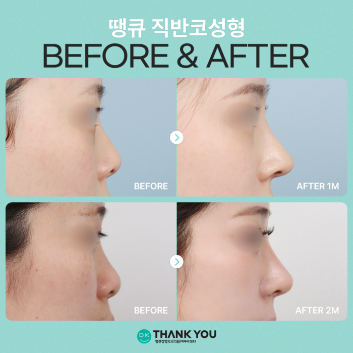 A Sophisticated Nose Line Completed with Semi-Straight Nose Surgery! image 7