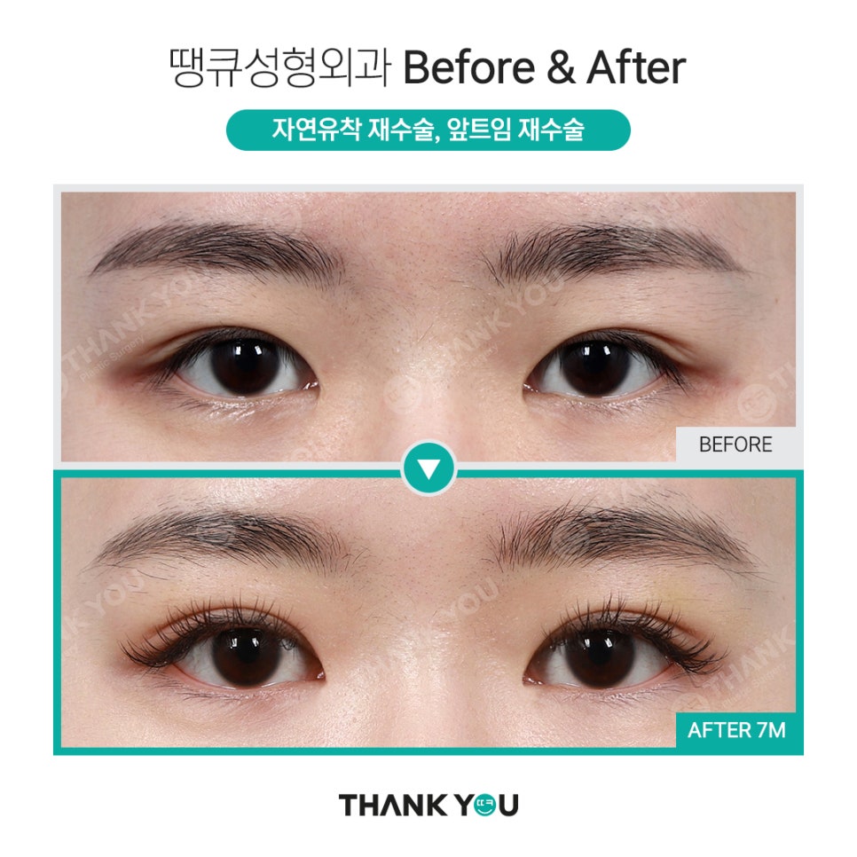 신논현역 성형외과에서 쌍수 전후 Check✨ 관련 이미지 1