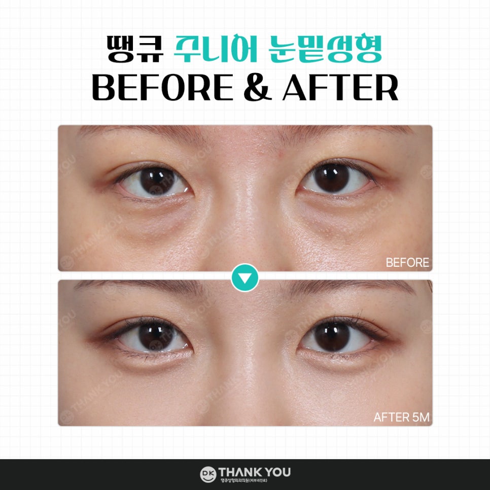 눈밑성형, 연령별로 달라지는 수술법! 무엇이 다를까? 관련 이미지 7