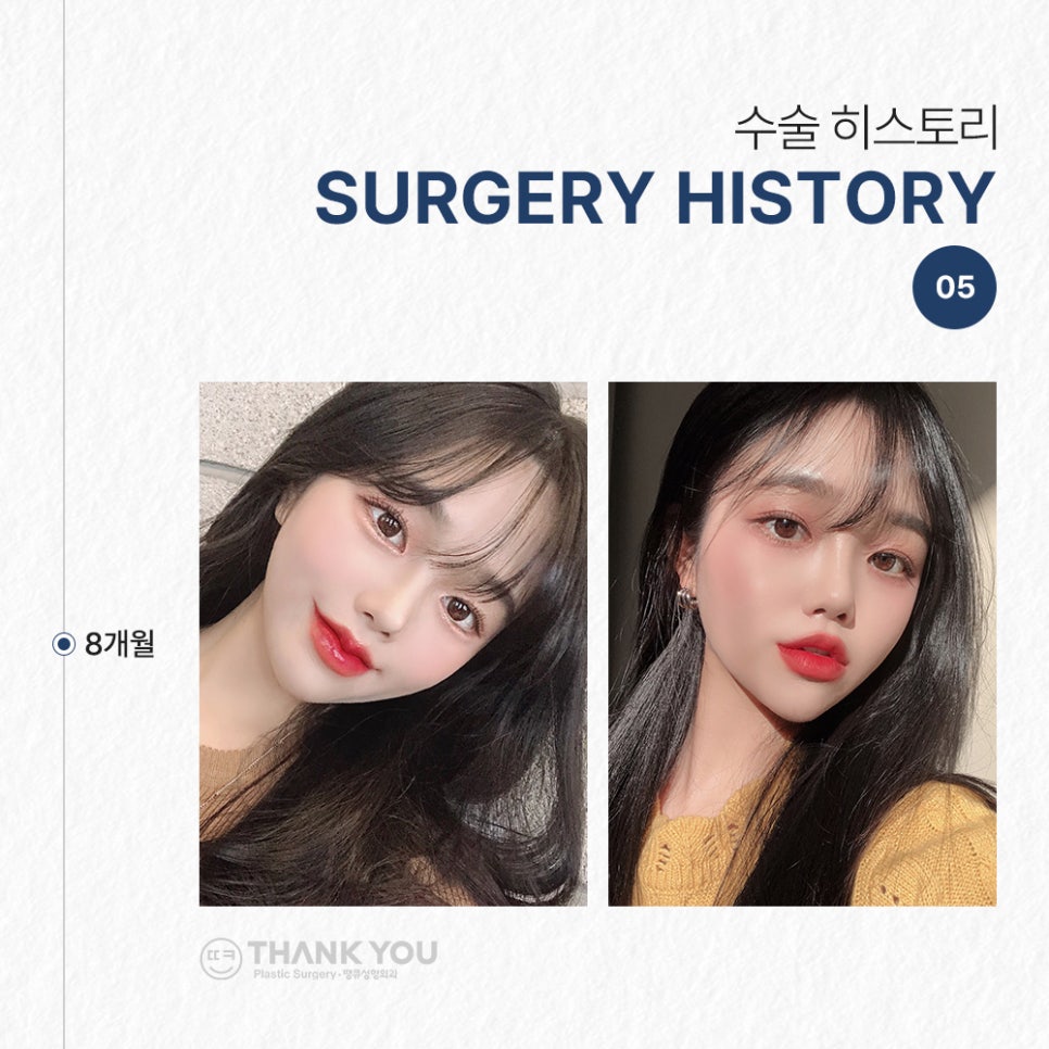 낮은코성형&얼굴지방흡입 후기 (땡큐성형외과 Real Story) 관련 이미지 8